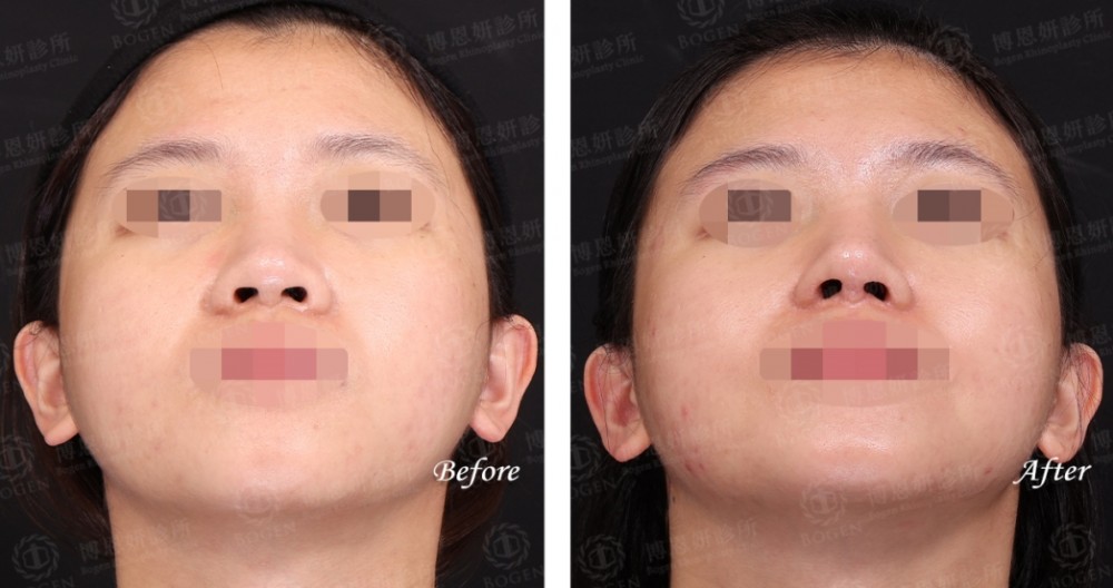 隆鼻術後口服A酸消腫更快,隆鼻與口服A酸,博恩妍